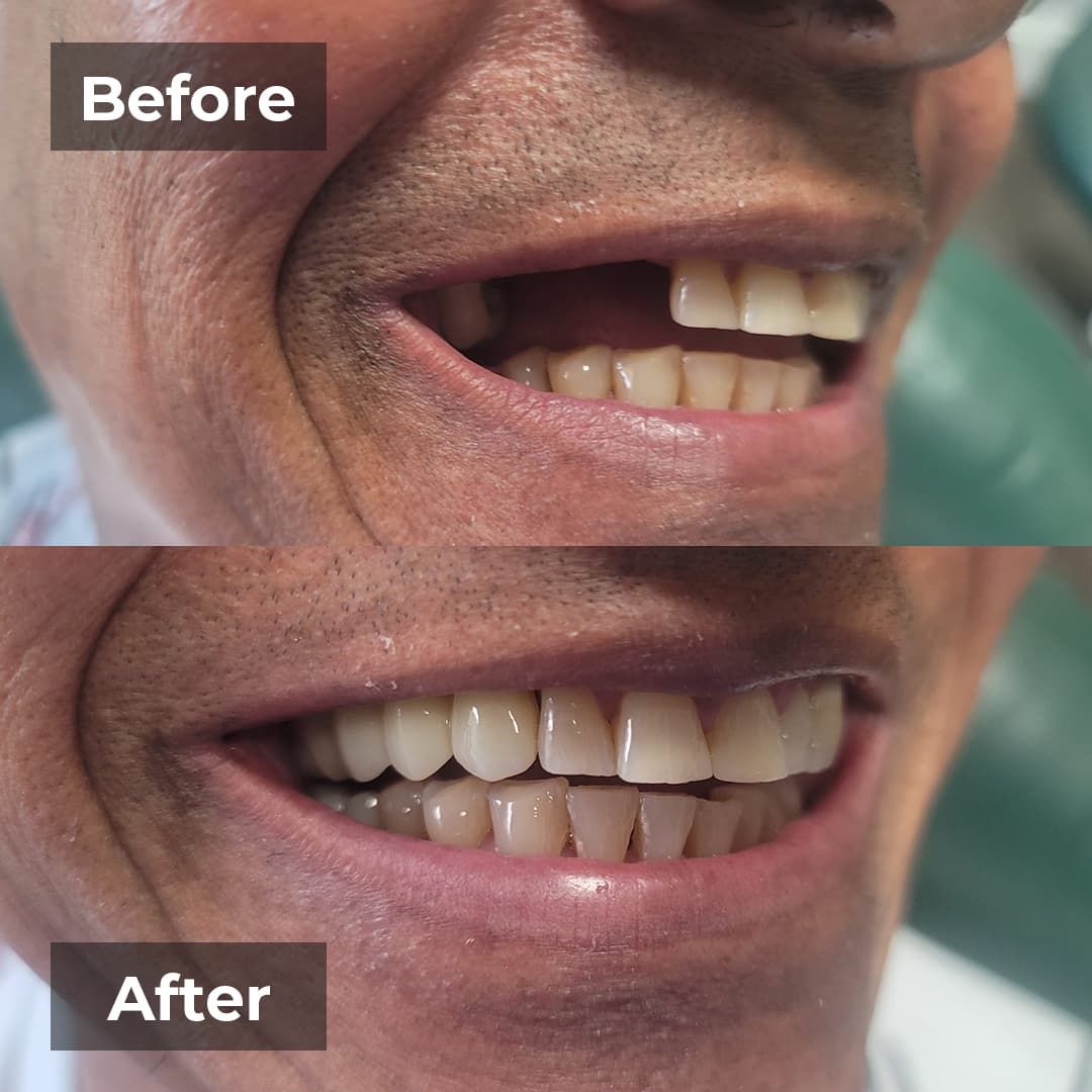 Before and after smile makeover case one
