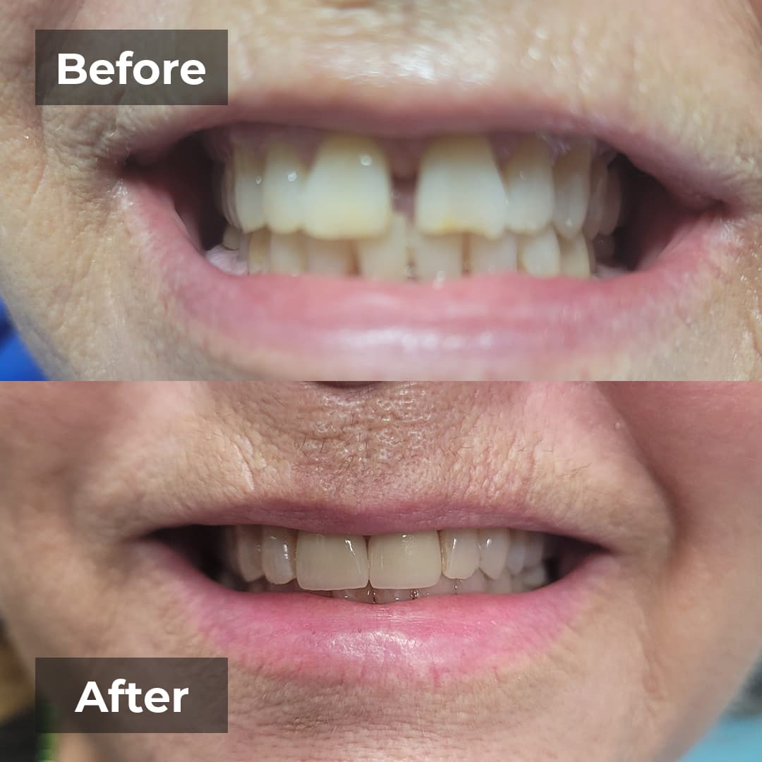 Before and after smile makeover case two