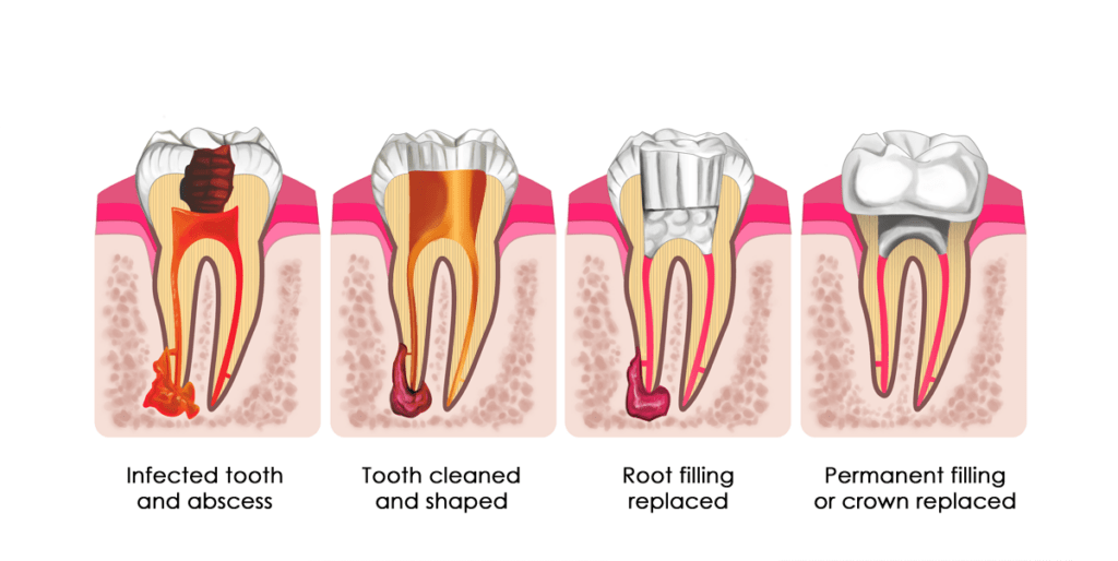Pips root canal therapy