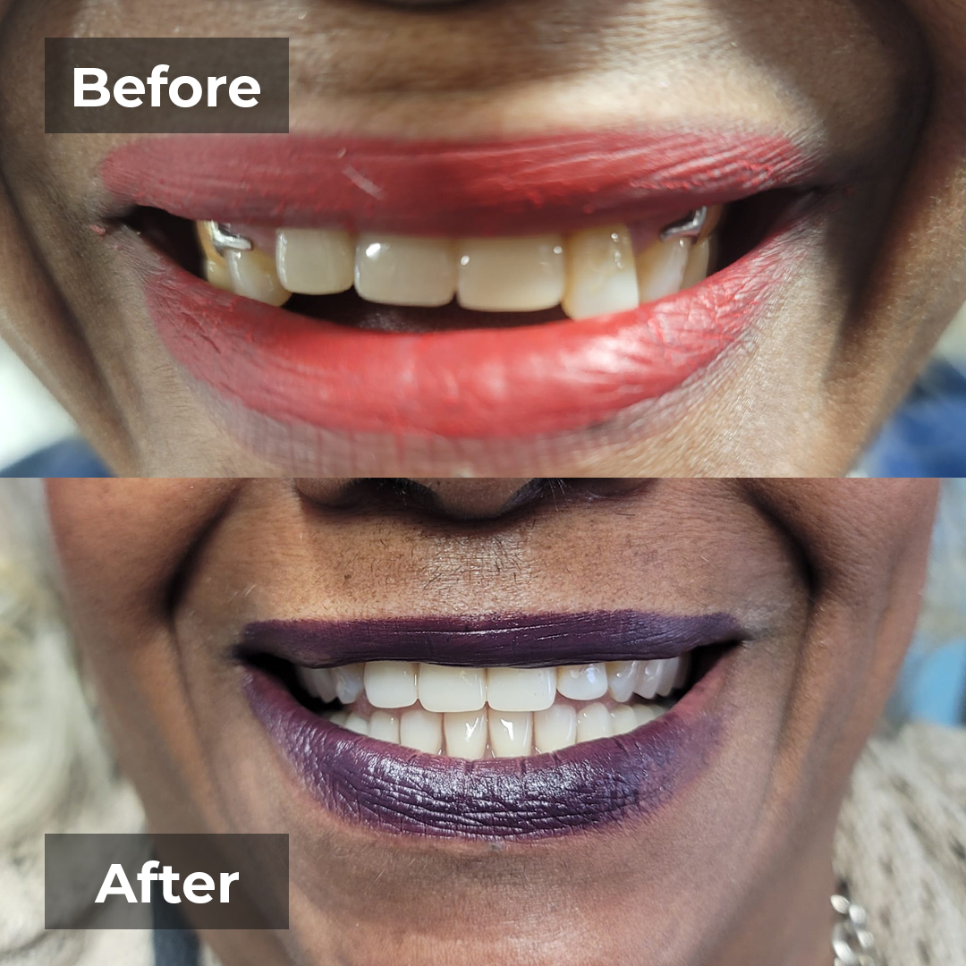 Before-after