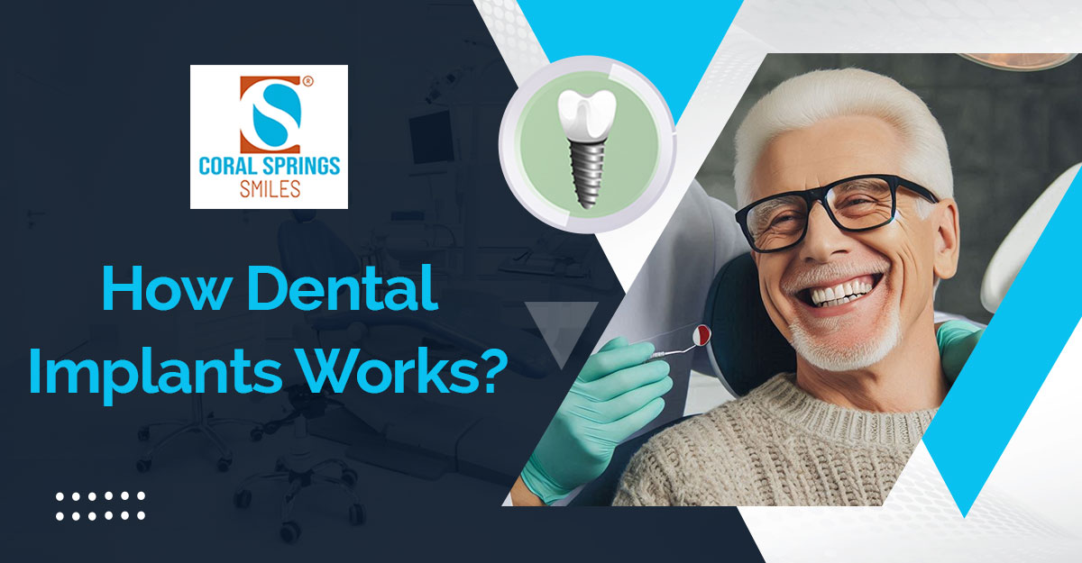 How Do Dental Implants Work