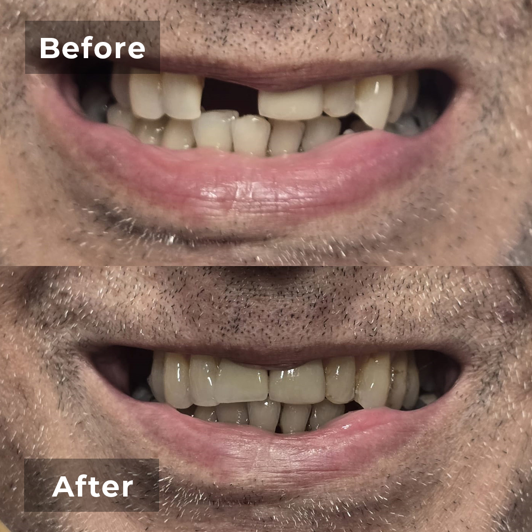 Before-after-7
