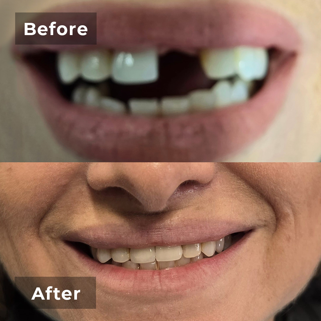 Before-after