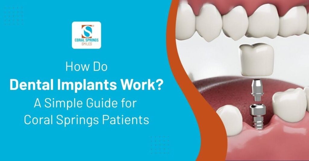 How Do Dental Implants Work?